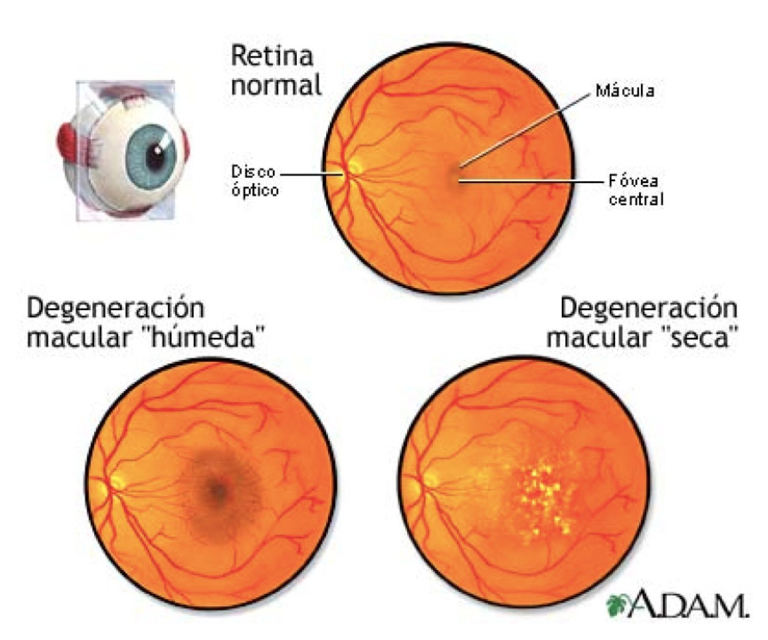 Imagen de la degeneración macular